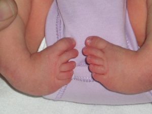 samira-club-foot-deformity